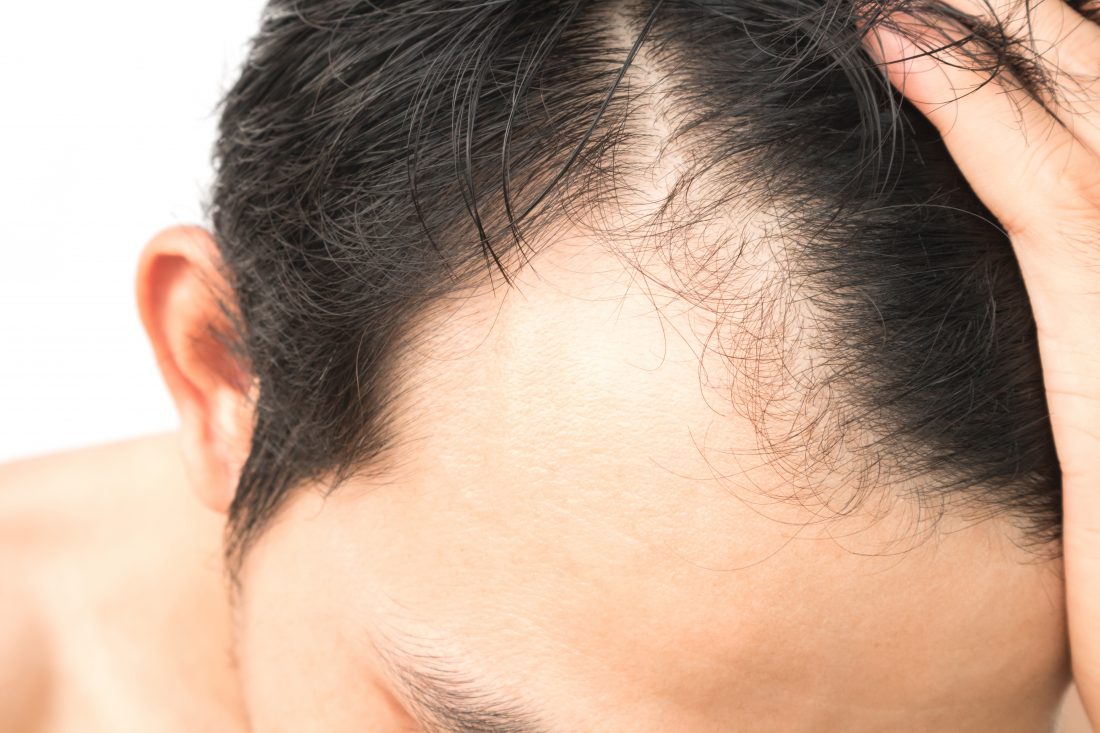 How To Find The Best Hair Transplant Surgeon In Thailand